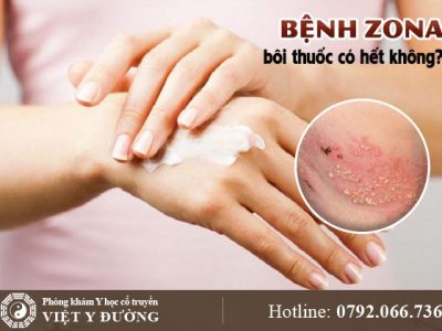 benh-zona-thuoc