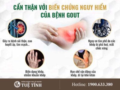 bien-chung-gout